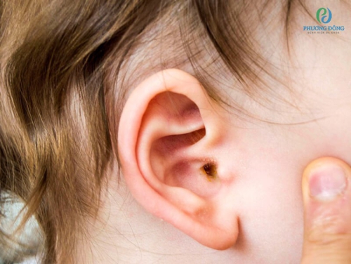 Nguyên nhân triệu chứng của viêm tai giữa có mủ và cách điều trị