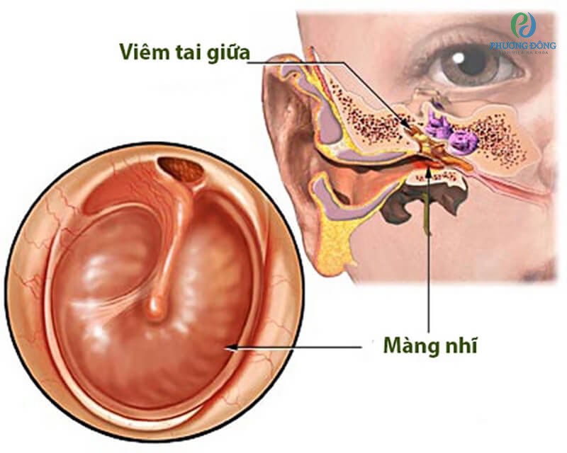 Viêm tai giữa ứ mủ là bệnh lý có nhiều biến chứng nguy hiểm