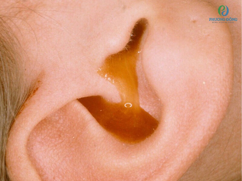 Viêm tai giữa ứ mủ có nhiều triệu chứng để nhận biết