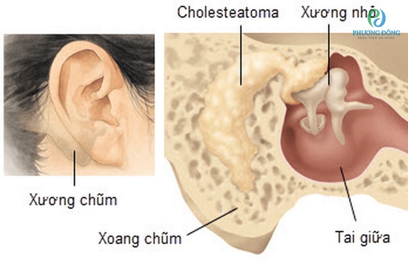 Viêm tai xương chũm là bệnh tổn thương viêm lan vào phần xương chũm 