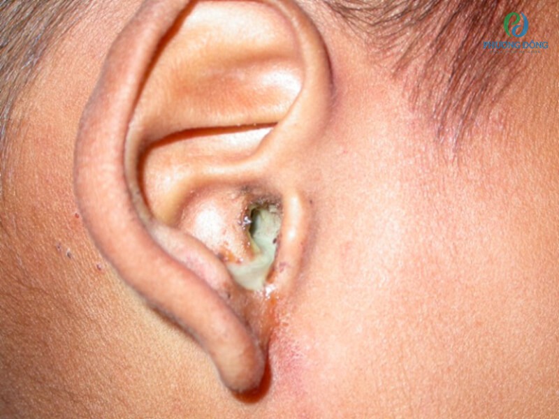 Viêm nhiễm tai trong xuất hiện do nhiều nguyên nhân khác nhau