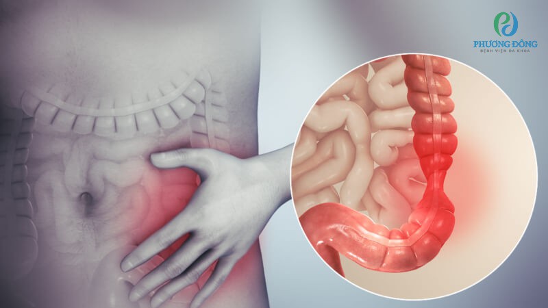 Lao ruột có thể dẫn đến các tổn thương ở đâu trong ống tiêu hóa?
