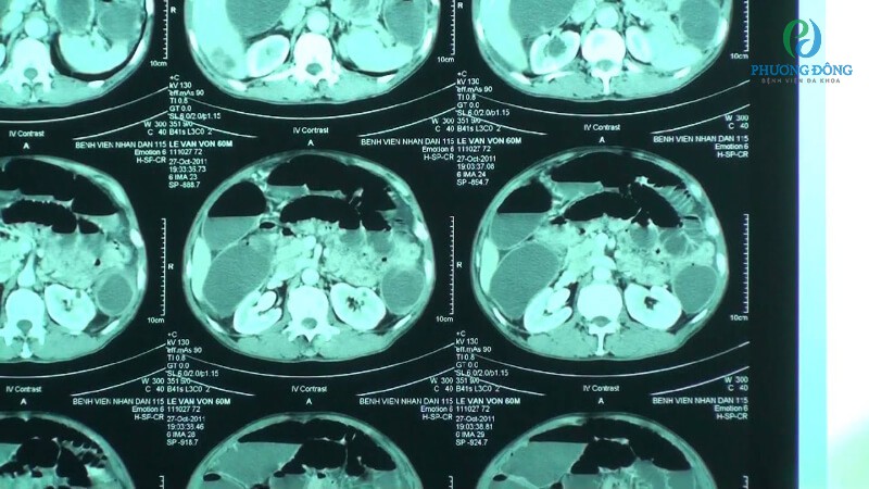Chụp cắt lớp CT cho ra kết quả chẩn đoán rõ ràng hơn