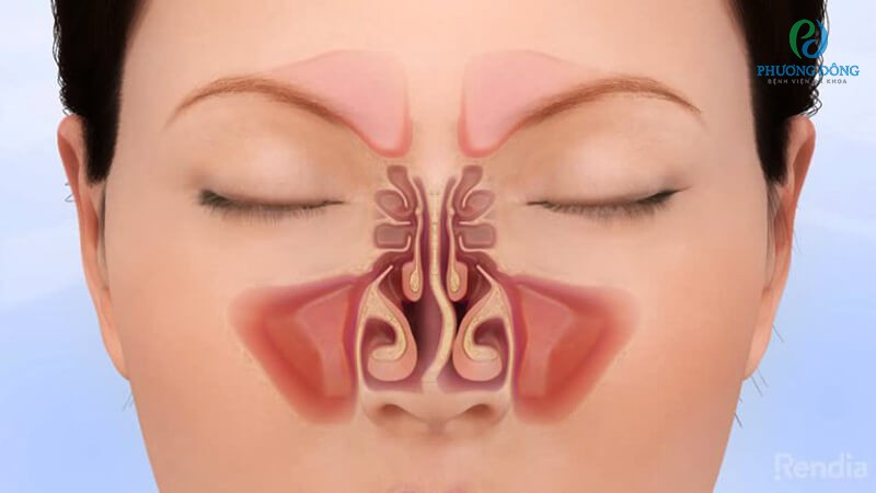 Lệch vách ngăn ở mũi là tình trạng mũi biến dạng bất thường