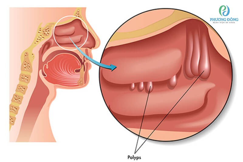 Polyp trong mũi là một bệnh lý thường gặp và không phải ung thư