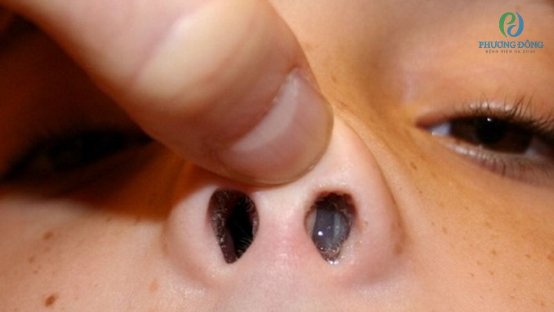 Polyp mũi ở trẻ nhỏ có lẽ là khái niệm khá xa lạ với nhiều bậc phụ huynh