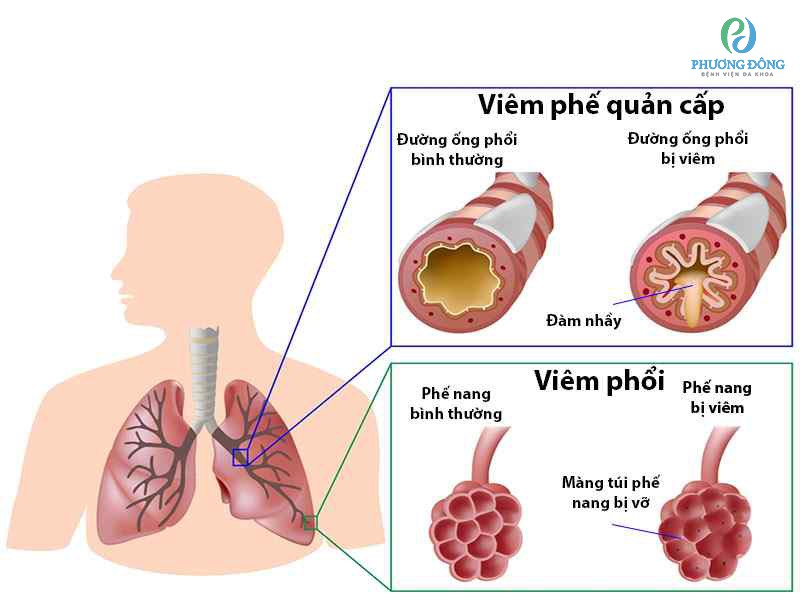 Viêm phổi, viêm phế quản đều liên quan đến viêm nhiễm hô hấp dưới