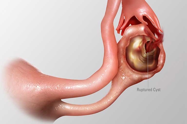 Dấu hiệu vỡ u nang buồng trứng và cách xử trí