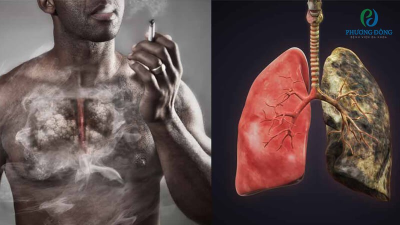 Ung thư phổi rất nguy hiểm và cần được tầm soát sớm