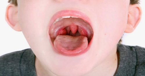 Viêm họng hạt ở trẻ em: Dấu hiệu và cách điều trị dứt điểm