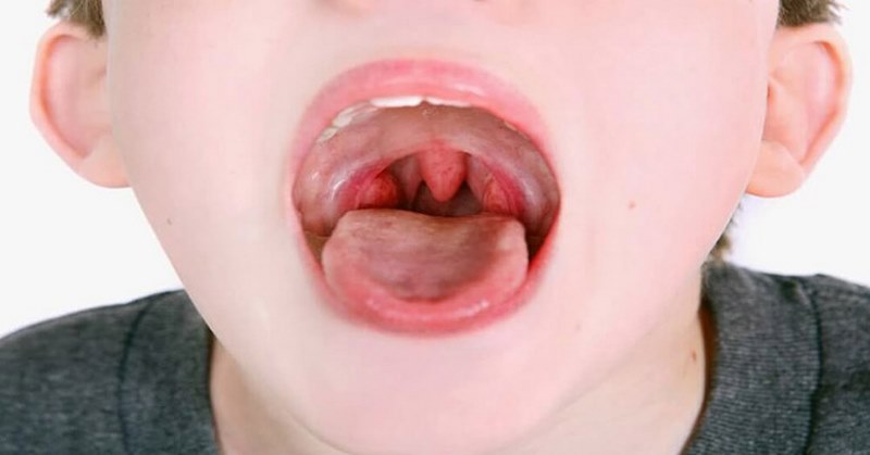 Triệu chứng và cách điều trị trẻ bị viêm họng hạt uống thuốc gì hiệu quả