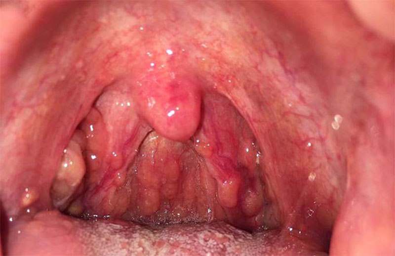Viêm họng hạt là một dạng bệnh của viêm họng mãn tính quá phát
