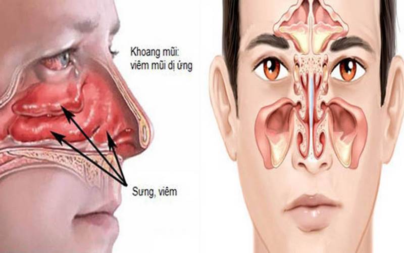 Viêm mũi do dị ứng có nhiều nguyên nhân
