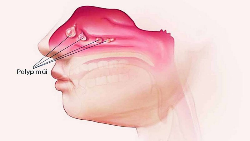 Polyp mũi phát triển cũng có thể là nguyên nhân gây bệnh