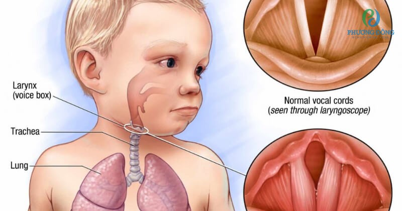 Trẻ em cũng là đối tượng bị mắc bệnh viêm dây thanh quản