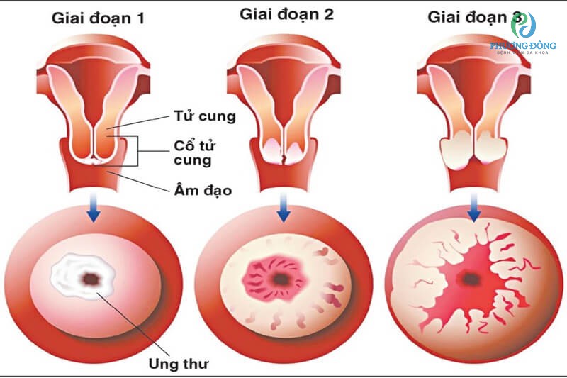 Ung thư vùng cổ tử cung trải qua 4 giai đoạn cơ bản