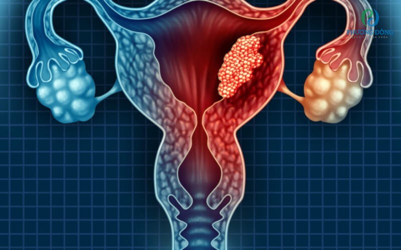 Ung thư vùng cổ tử cung để lại rất nhiều biến chứng nguy hiểm