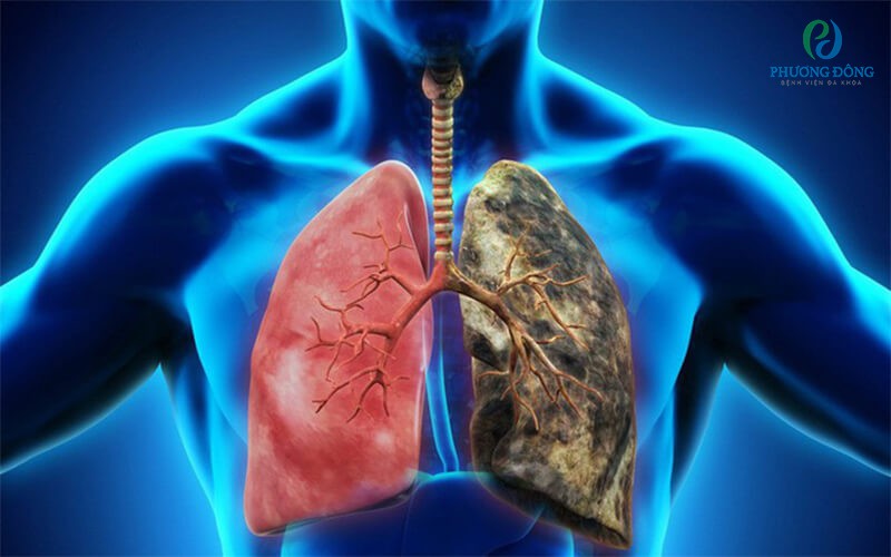 Ung thư phổi là căn bệnh rất phổ biến trong cộng đồng hiện nay