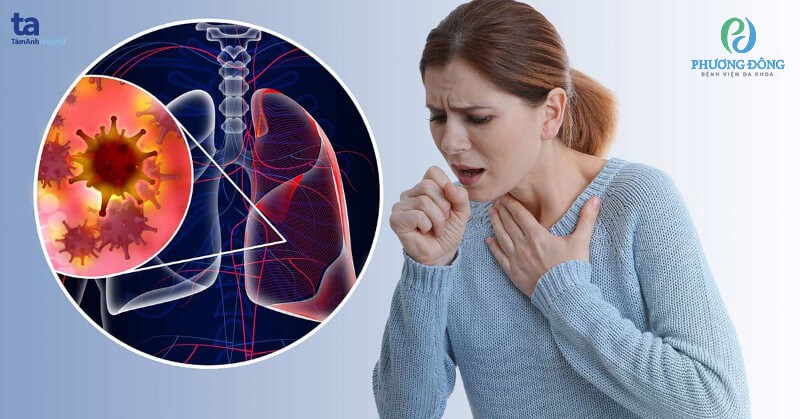 Ho là biểu hiện đầu tiên khi mắc bệnh liên quan đến phổi
