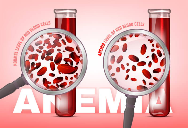 Thiếu máu là biểu hiện đặc trưng của bệnh ung thư bạch cầu