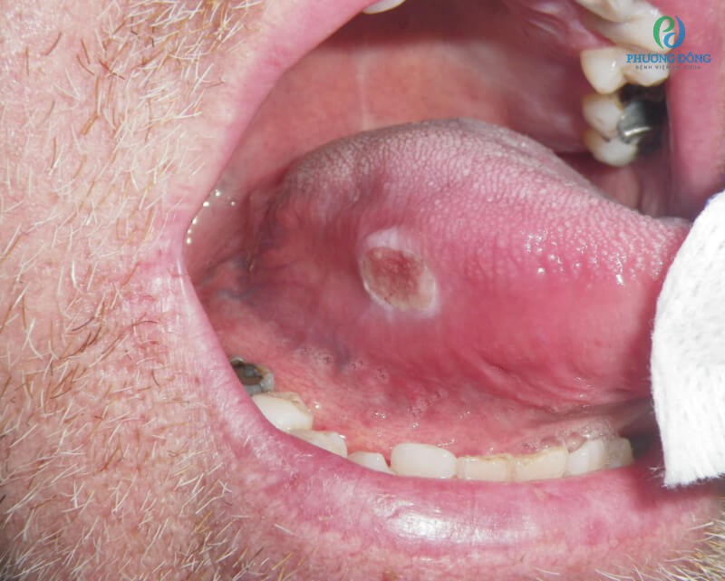 Bệnh ung thư phần lưỡi phát triển qua 4 giai đoạn khác nhau