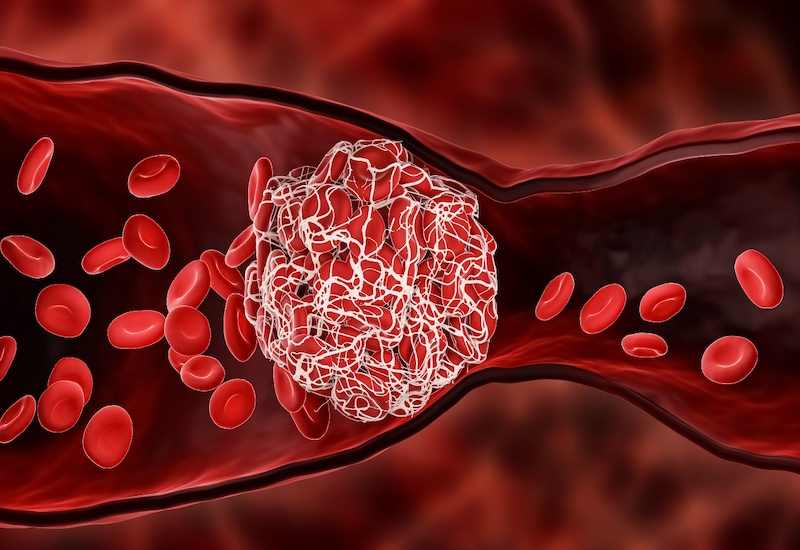 Khối u trong gan khiến máu khó lưu thông qua tĩnh mạch gây ra giãn tĩnh mạch