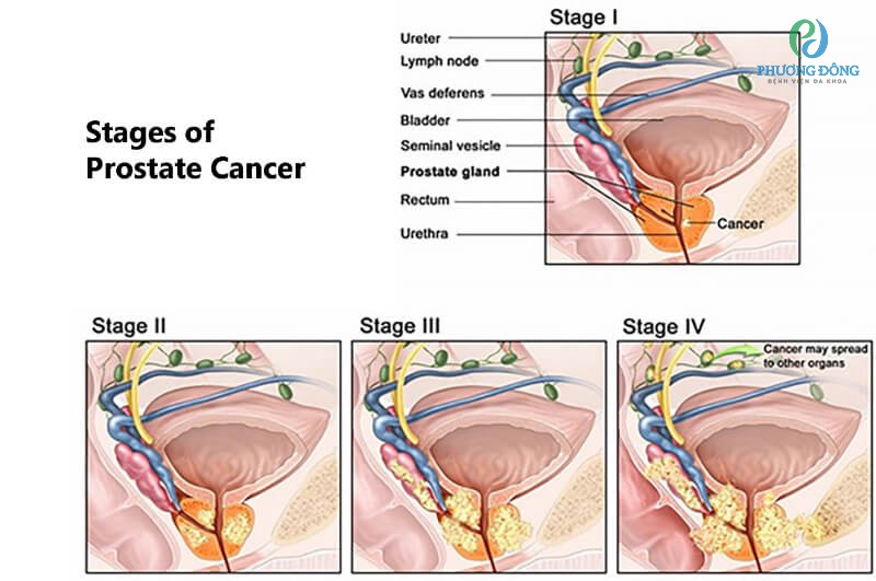 giai đoạn ung thư tiền liệt tuyến tiến triển âm thầm