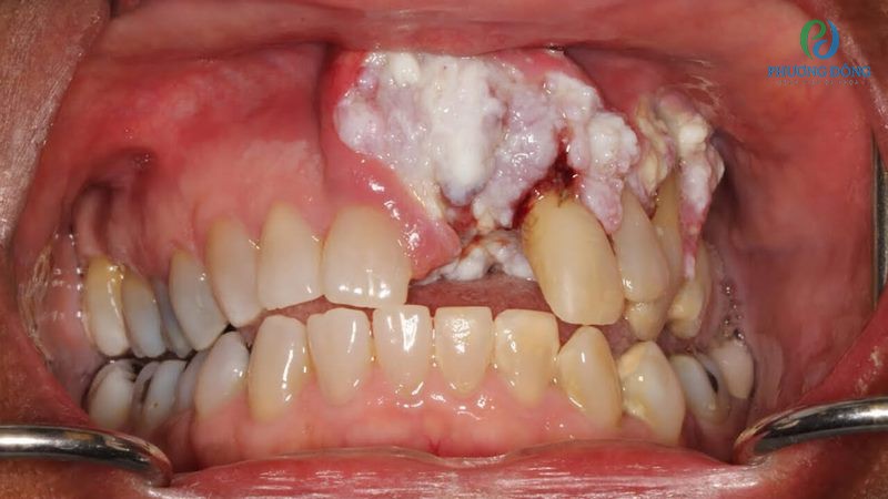 Hình ảnh ung thư nướu răng