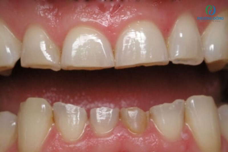 Răng bị mòn một trong những dấu hiệu của bệnh ung thư nướu răng