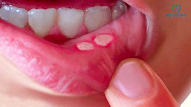Viêm loét miệng là triệu chứng thường gặp của bệnh ung thư nướu