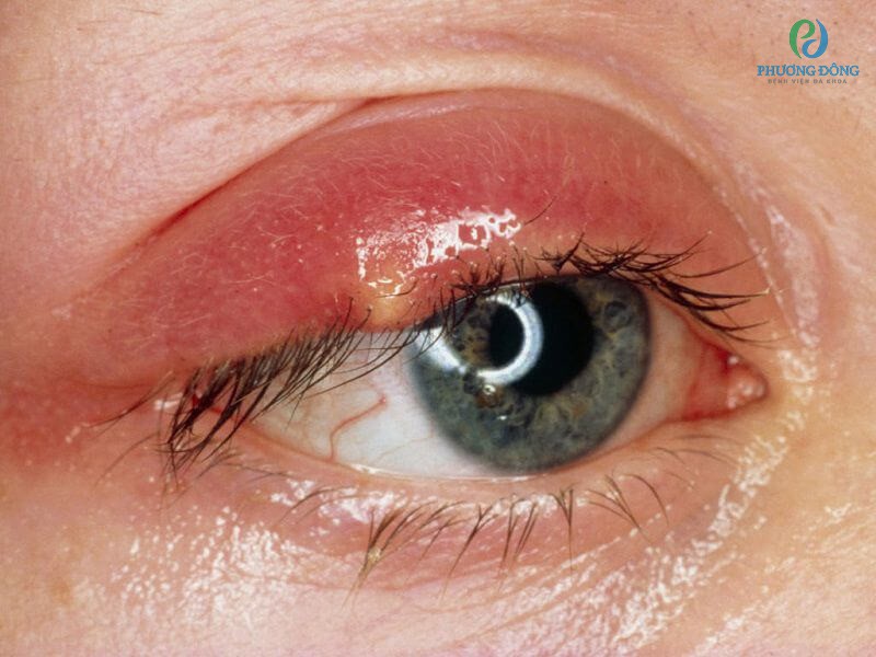 Các tế bào ở mắt phát triển bất thường gây bệnh ung thư