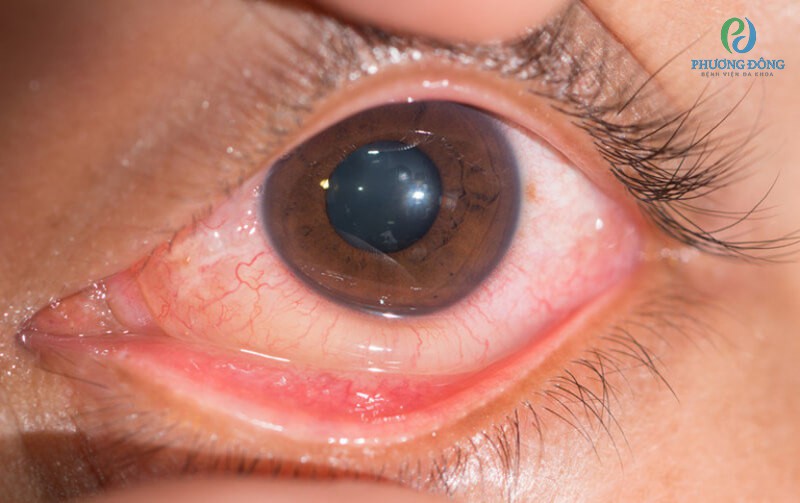 Ung thư ở mắt có nhiều dấu hiệu biển hiện khác nhau