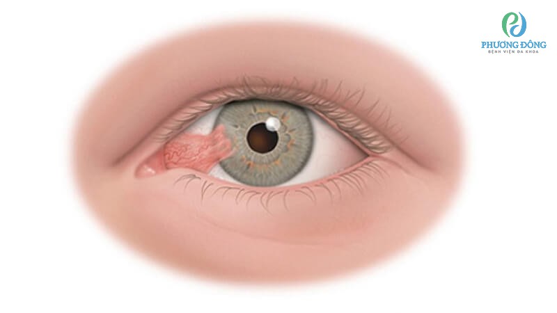 Nguyên nhân gây ra ung thư mắt là gì?
