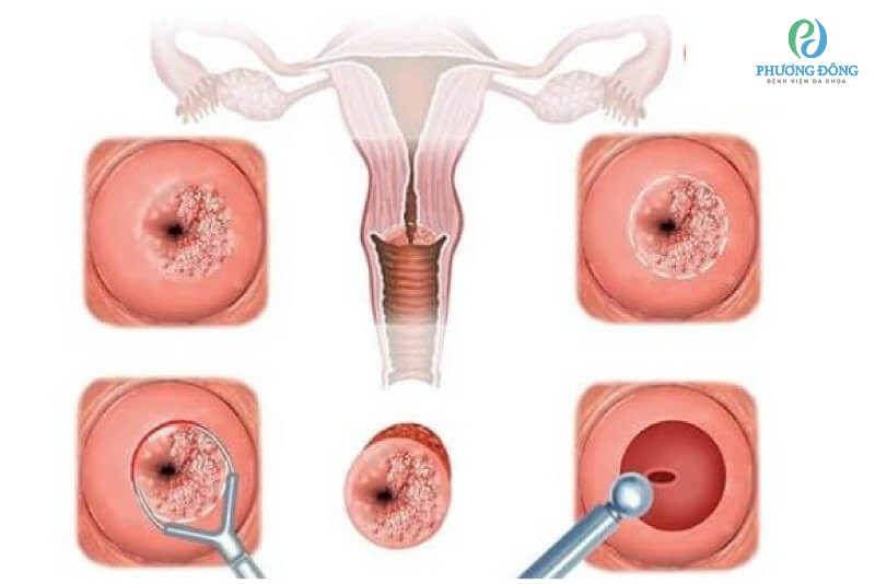 Bệnh tử cung xuất hiện rất nhiều ở nữ giới