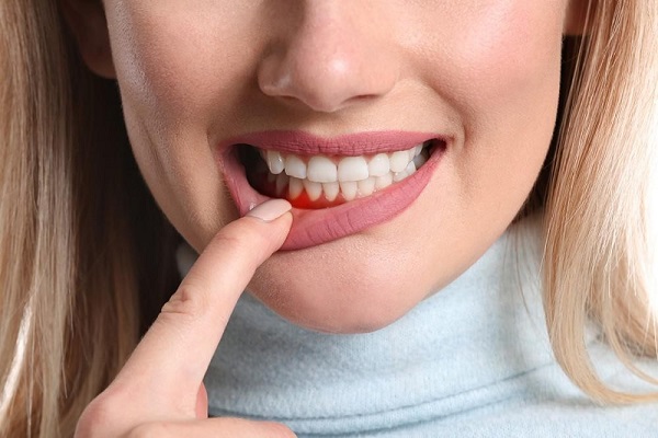 Chảy máu chân răng có thể bắt nguồn từ nhiều nguyên nhân khác nhau