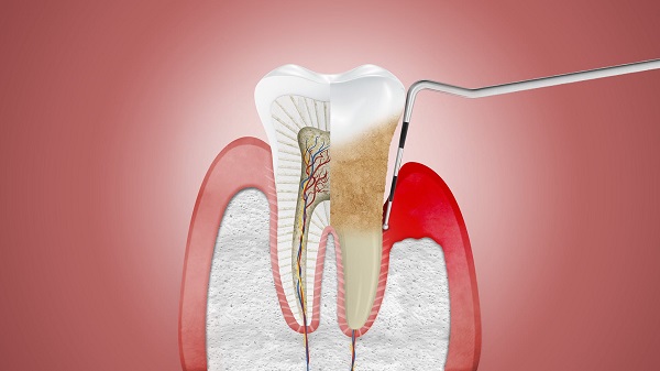 Phương pháp điều trị chảy máu chân răng do viêm nha chu 