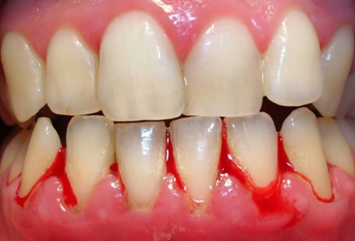 Giải đáp chảy máu chân răng do đâu? Triệu chứng và cách phòng ngừa