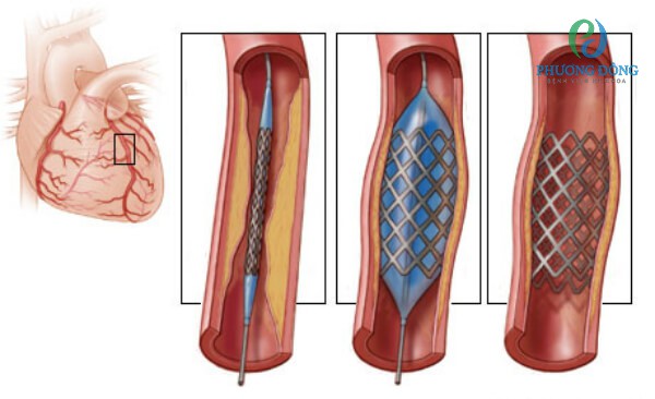 Đặt stent động mạch vành cho người nhồi máu cơ tim cấp