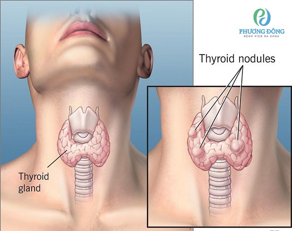 Tìm hiểu về nhân tuyến giáp và chế độ dinh dưỡng phòng ngừa