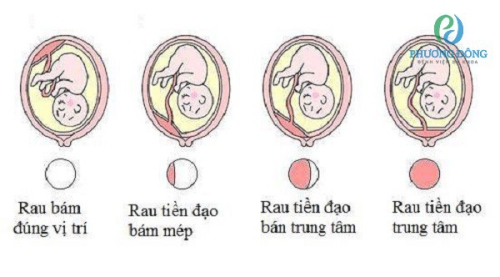 Rau tiền đạo: Nguyên nhân và cách điều trị