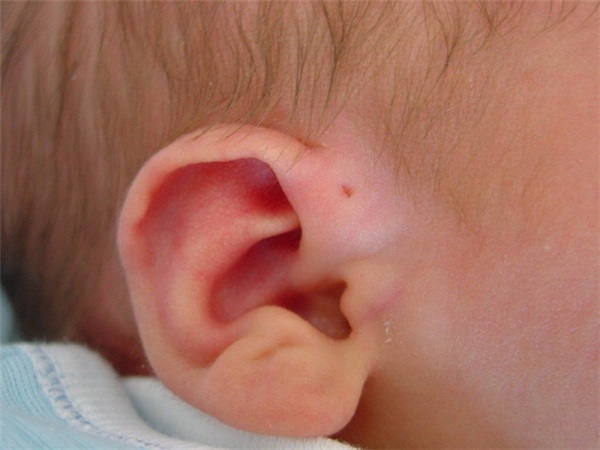 Rò luân nhĩ là dị tật bẩm sinh ở tai, hình thành vào tuần thứ 6 của thai kỳ