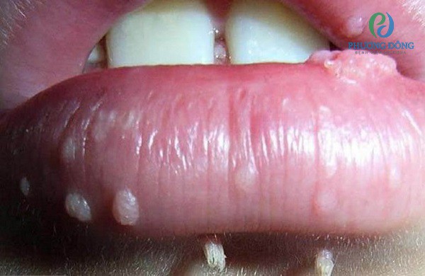 Bệnh sùi mào gà xuất hiện ở miệng do virus HPV gây ra 
