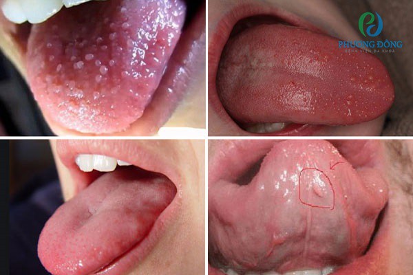 Sự khác biệt giữa nốt u nhú ở miệng và nhiệt miệng