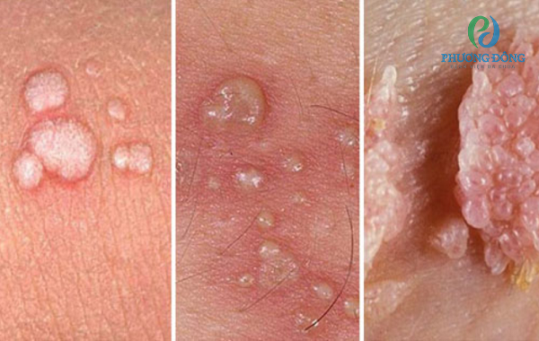 Nguyên nhân chính gây ra bệnh sùi mào gà ở nam giới do HPV