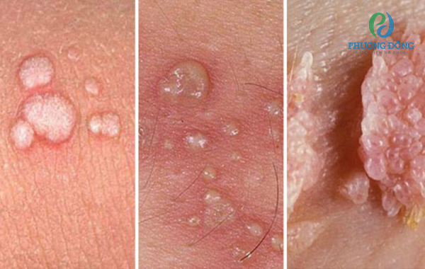 Các nốt sùi do nhiễm virus HPV tạo thành ở âm đạo