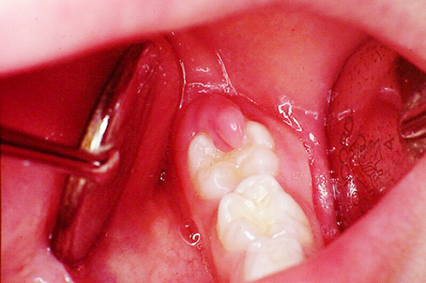 Răng mọc sai hướng khiến vệ sinh răng miệng gặp khó khăn