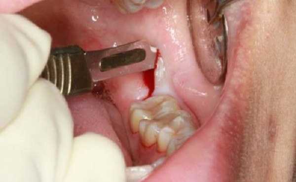Phương pháp cắt bỏ lợi trùm đối với răng khôn mọc thẳng 