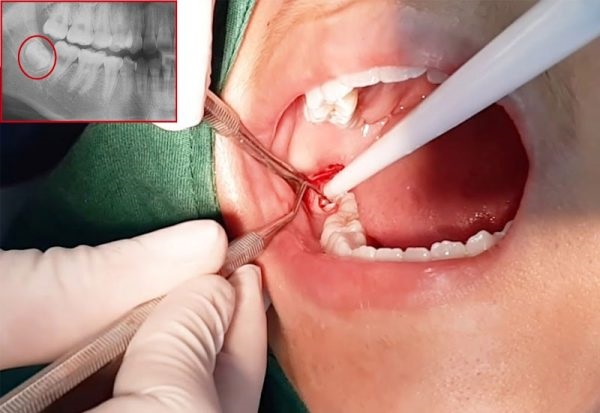 Nha sĩ thực hiện phương pháp nhổ răng khôn mọc lệch