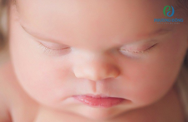 Mũi thai nhi quá thấp có nguy cơ mắc hội chứng Down