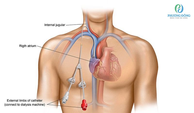 Đặt ống catheter vào tĩnh mạch ở ngực để điều trị thuyên tắc ối